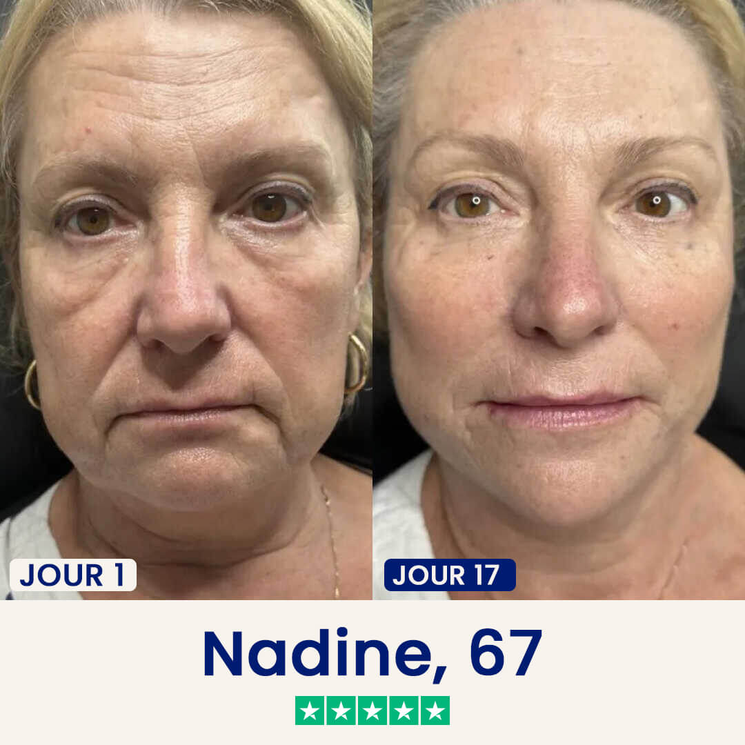 Le Dermline™ Lift